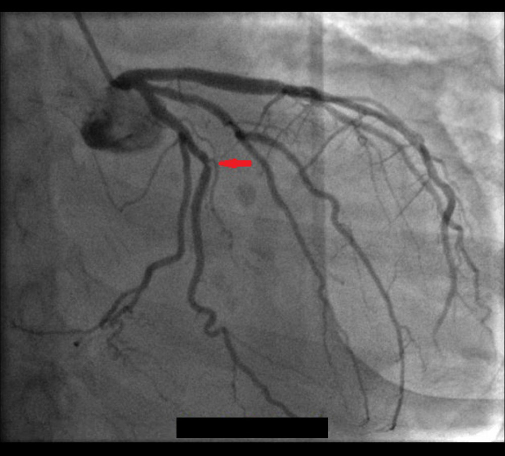 Coronary angiography of the circumflex artery: Illustration of a 60% circumflex stenosis highlighted by arrow.