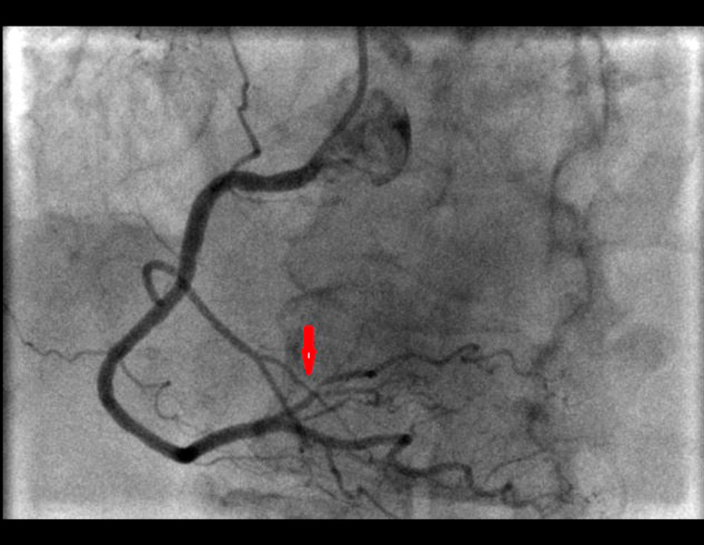 Coronary angiography of the right coronary artery: Illustration of a 80% stenosis of the small right posterior branch highlighted by arrow.