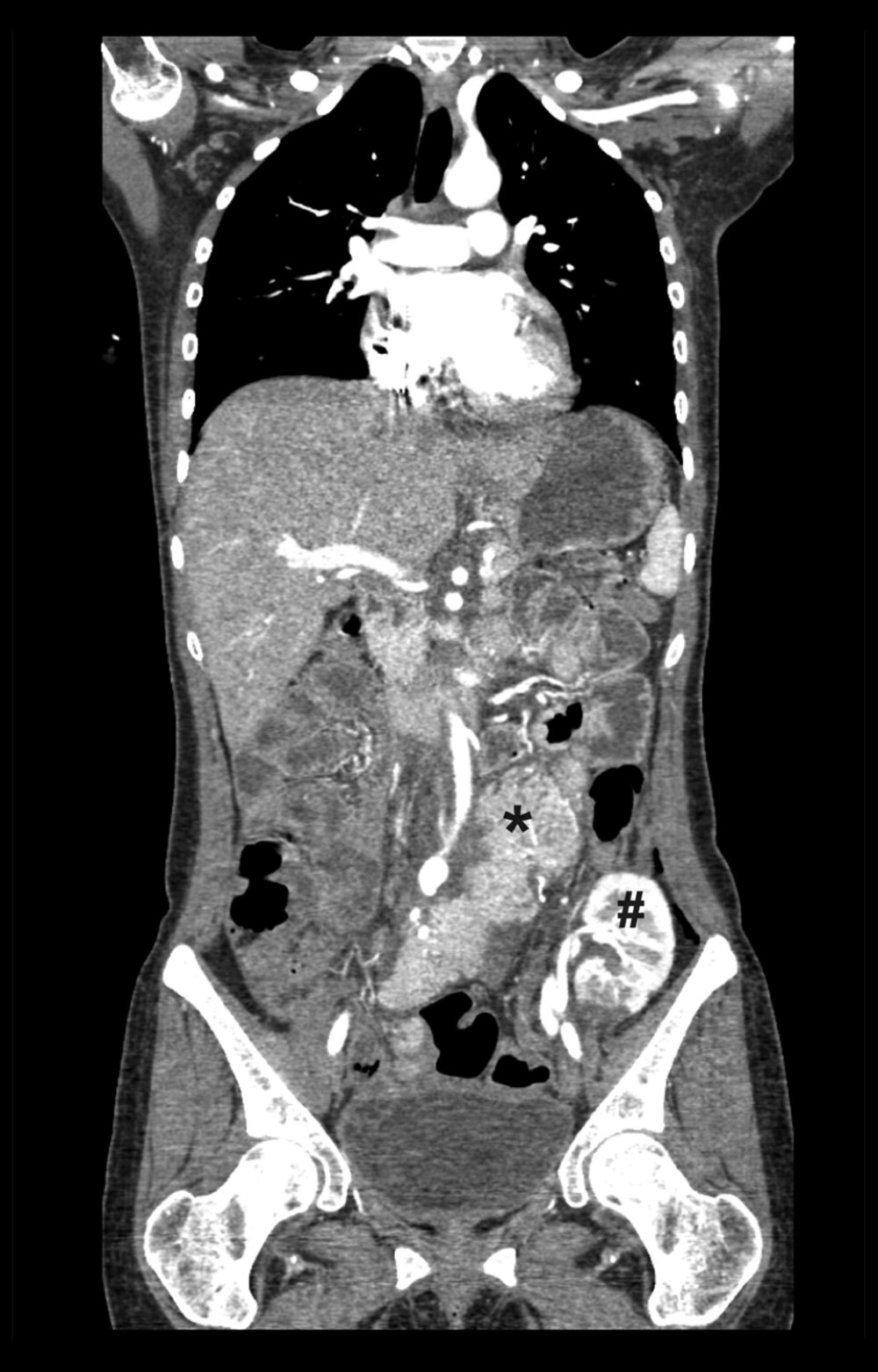 Radiologic followup after combined kidney-pancreas transplantation. Computed tomography prior to pregnancy showing the functional and well-perfused pancreas (marked with a black asterisk) and kidney grafts (marked with black pound sign).