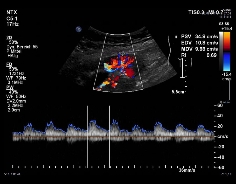 Radiologic followup after combined kidney-pancreas transplantation with successful pregnancy. Doppler ultrasound of the kidney graft at gestational week 16 indicating good perfusion.