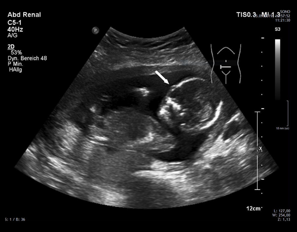 Radiologic followup after combined kidney-pancreas transplantation with successful pregnancy. Ultrasound of the intrauterine embryo at gestational week 16; white arrow indicates embryonal head inside the womb.