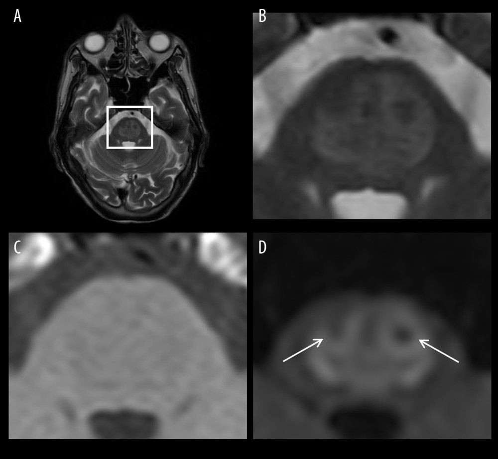 Axial MRI scans taken on the day of disease onset. (A) T2-weighted (T2W) image at the level of the pons. (B) Enlarged T2W image of the square region indicated in (A) showing the central pontine lesion as a slightly high-signal area. (C) Enlarged T1-weighted (T1W) image of the square region indicated in (A) showing the central pontine lesion as a slightly low-signal area. (D) Enlarged diffusion-weighted (DW) image of the square region indicated in (A) showing the central pontine lesion as an apparently high-signal area resembling a piglet sign. Arrows indicate relatively spared descending corticospinal and corticobulbar tracts (the nostrils of the pig snout) within the lesion.