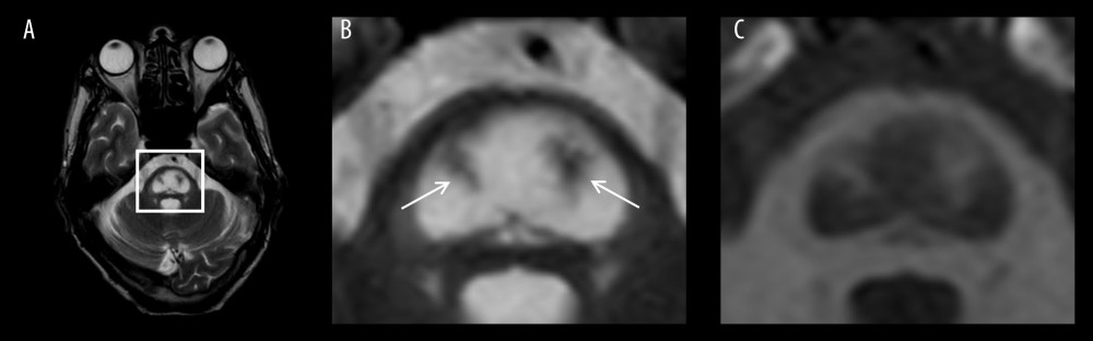 Axial MRI scans taken 11 weeks after disease onset. (A) T2W image at the level of pons. (B) Enlarged T2W image of the square region indicated in (A) showing the clear central pontine piglet sign as a well-defined high-density area. Arrows indicate spared descending corticospinal and corticobulbar tracts (the nostrils of the pig snout) within the lesion. (C) Enlarged T1W image of the square region indicated in (A) showing the central pontine piglet sign as a low-density area.