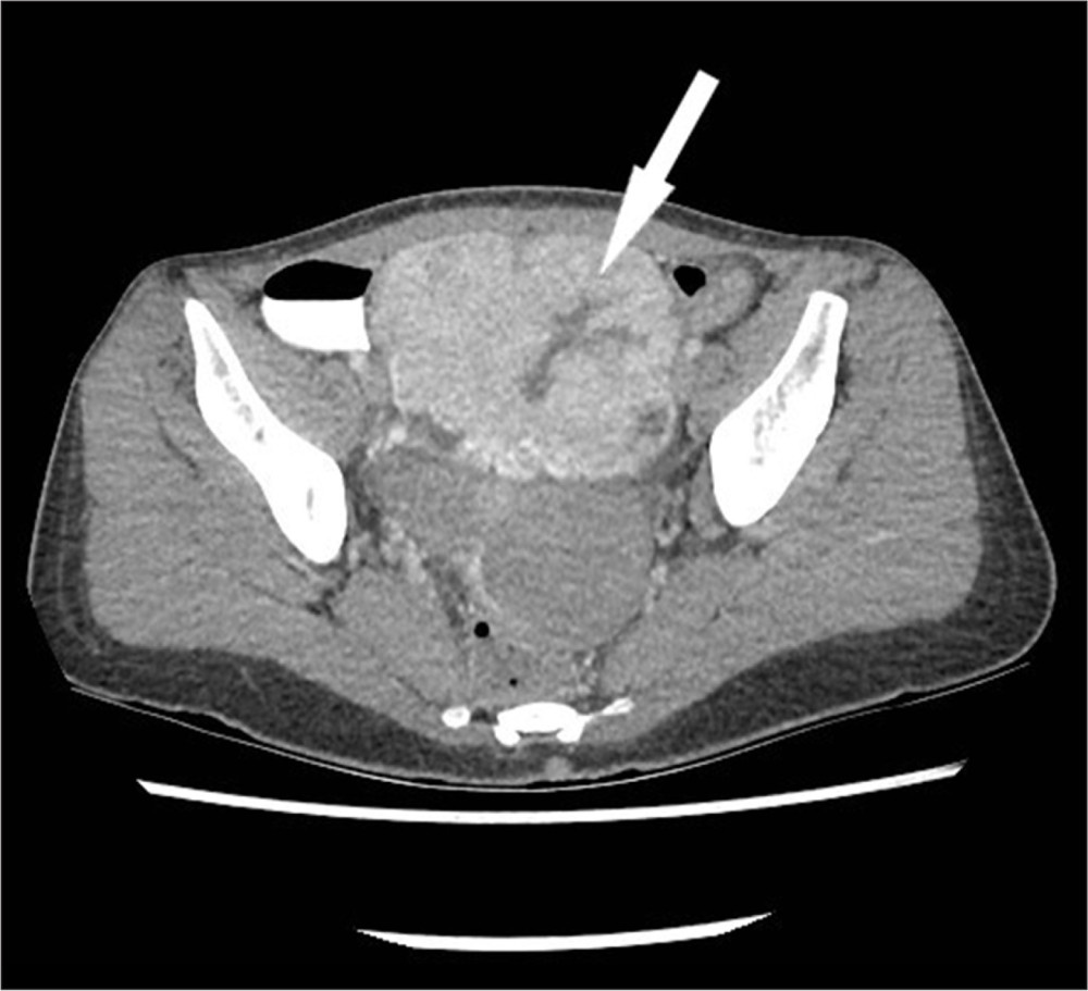 Single-phase computed tomography (CT) enterography of the abdomen and pelvis showing a large, heterogeneously enhancing hypervascular mass in the pelvis that measures 9.1×10.5×10.0 cm (maximal anteroposterior x transverse x cephalocaudal dimension), anterior to the uterus with atypical enhancement for fibroid (arrow).