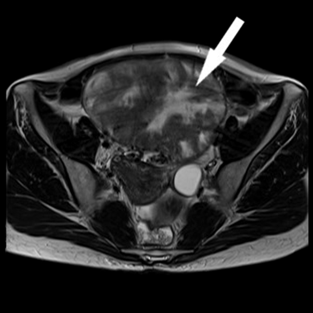 Magnetic resonance imaging of the abdomen and pelvis T2-weighted signal showing the ovarian tumor (arrow), 9.4×11.3×12.5 cm (maximal anteroposterior× transverse×cephalocaudal dimension), with decreased exterior margination smooth surface and internal solid tissue containing irregular areas of T2-weighted signal.