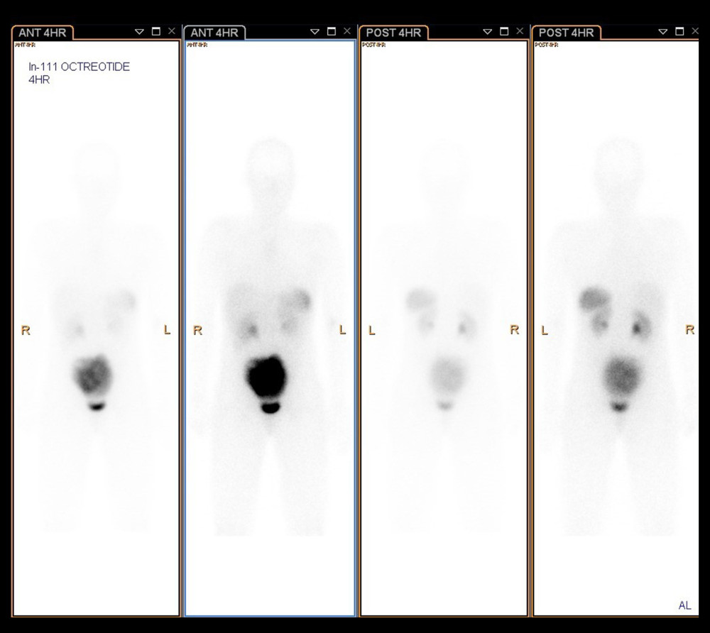 Nuclear medicine Indium-111 octreotide scintigraphy of the whole body showing an intensely octreotide-avid mass in the anterior pelvis, superior to the bladder measuring 8.5×12.8×13.8 cm. No other octreotide-avid lesions are seen within the abdomen or pelvis.