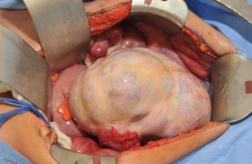 Photographs of the ovarian mass weighing 780 g and was 14×14×8 cm.