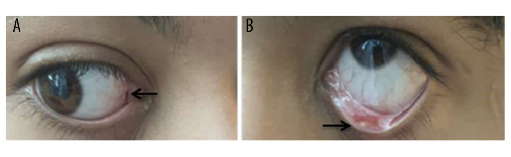 (A, B) A 14-year-old Saudi boy with gynecomastia, Cushing syndrome, large-cell calcifying Sertoli cell tumor of the testis, and Carney complex. The eyes show lentigines in the conjunctival membranes (arrows).