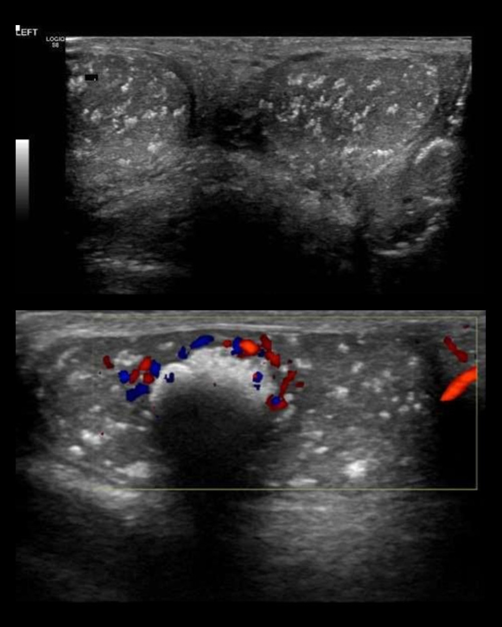 A 14-year-old Saudi boy with gynecomastia, Cushing syndrome, large-cell calcifying Sertoli cell tumor of the testis, and Carney complex. Testicular ultrasound imaging of the testes shows diffuse calcifications within the tumor tissue (arrows).