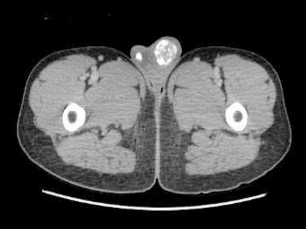 Computed tomography ( CT ) scan of the pelvis showed bilateral testicular calcification more on the left side.