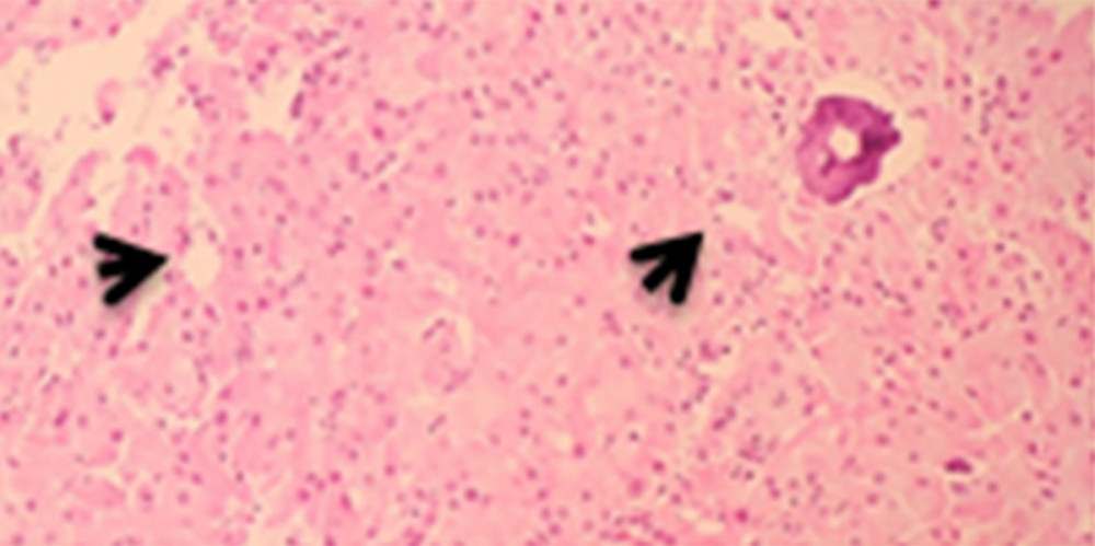Photomicrograph of the diagnostic histopathology of a large cell calcifying Sertoli cell tumor of the testis in a 14-year-old Saudi boy. The tumor consists of cords and nests of uniform pale eosinophilic cells with small regular nuclei. There is no necrosis, and no mitoses are present. A focus of microcalcification is seen (arrow), which is typical of large cell calcifying Sertoli cell tumor of the testis. Hematoxylin and eosin (H&E). Magnification ×40.