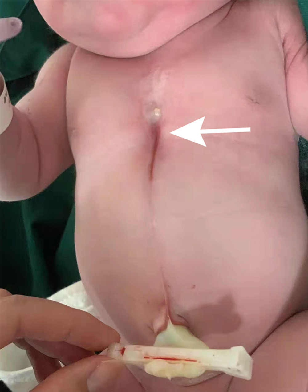 A newborn girl with an isolated congenital superior sternal cleft in the middle of the chest and extended to the root of the umbilical cord.