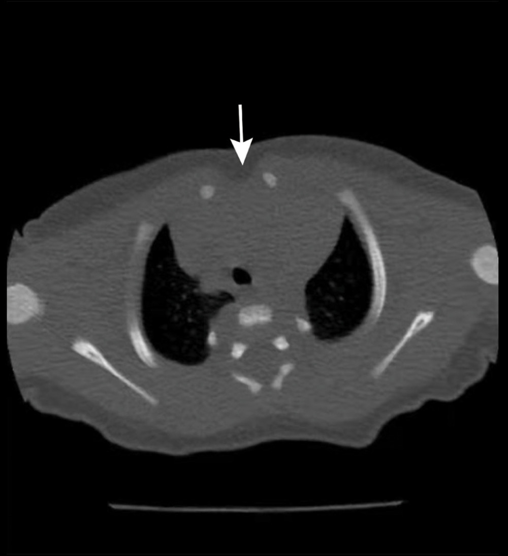 Thoracic CT with no contrast agent injected indicating the unclosed sternum (arrow).
