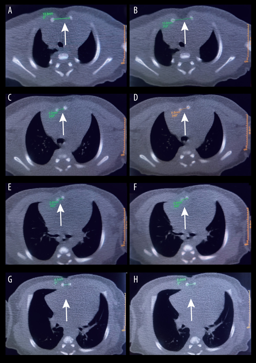 The specific data of the cracks between the 4 unclosed sternal segments that together constitute the sternum body of this newborn at the same level of the sternal separation. (A) Distance between the inner edges of the first sternal segment is 12.8 mm; (B) Distance between centers of the first sternal segment is 15.8 mm; (C) Distance between the inner edges of the second sternal segment is 4.5 mm; (D) Distance between centers of the second sternal segment is 6.8 mm; (E) Distance between the inner edges of the third sternum is 2.6 mm; (F) Distance between centers of the third sternum is 4.4 mm; (G) Distance between the inner edges of the fourth sternum is 4.1 mm; (H) Distance between centers of the fourth sternum is 6.4 mm (arrow).