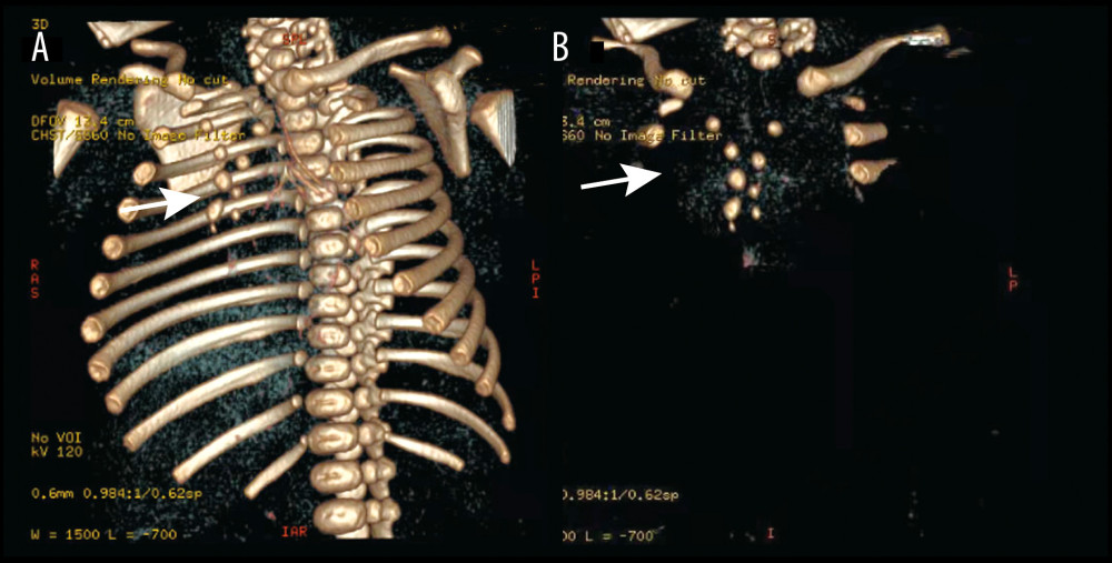 Three-dimensional reconstruction CT examination results of this newborn with a sternal cleft. (A) Three-dimensional reconstruction CT of the chest showing unclosed sternum and no deformity of the ribs and spine; (B) Local three-dimensional reconstruction CT of the sternum showing the unclosed sternum (arrow).