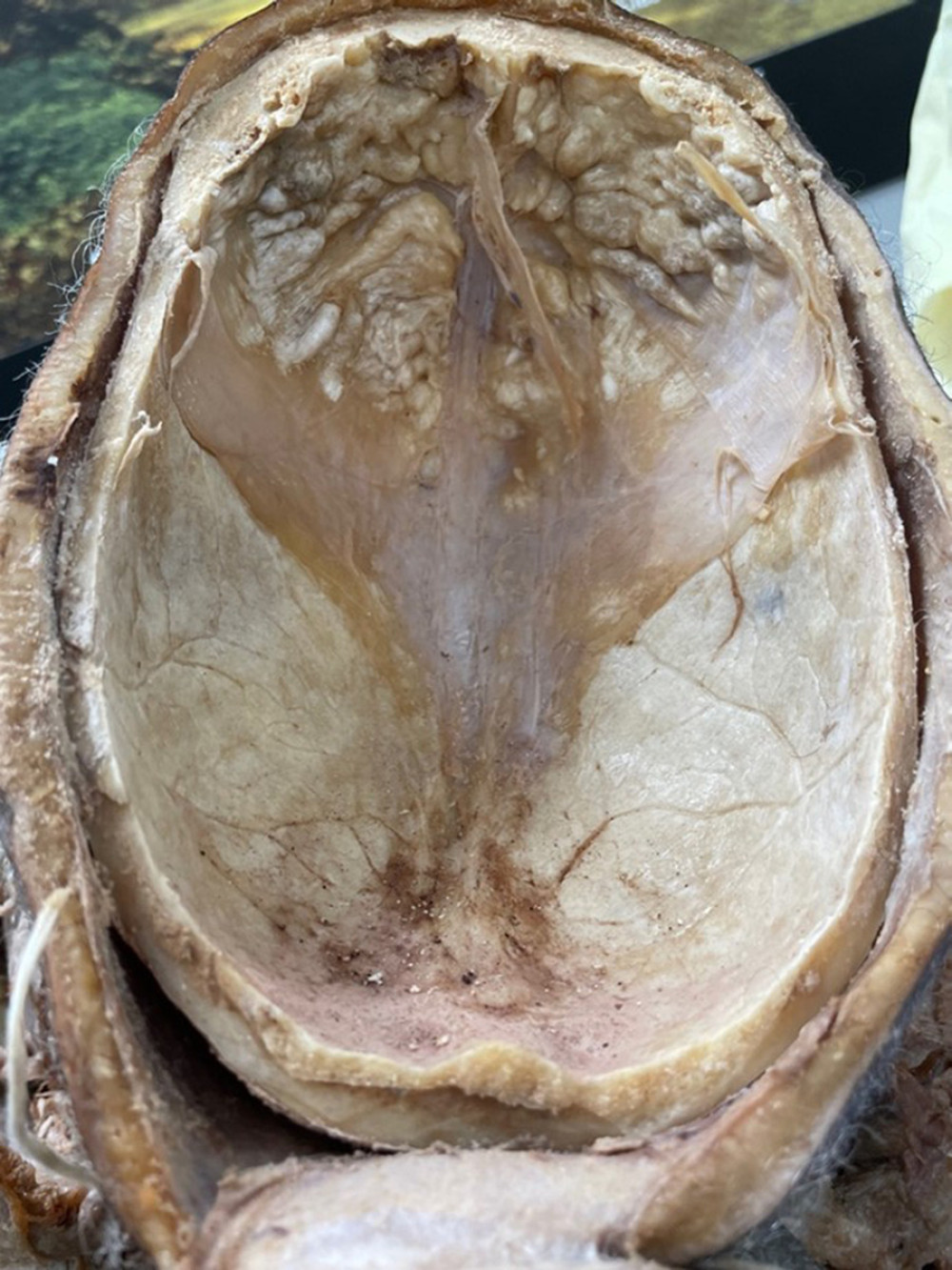 The top half of the donor’s skull showing the bumpy nature of the overgrowths found.