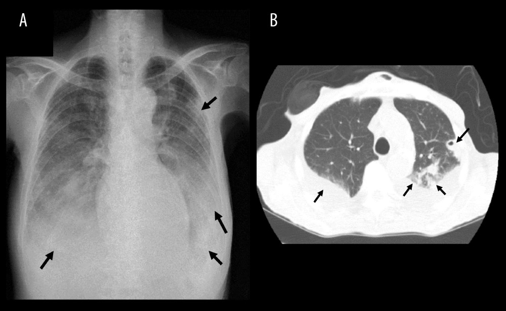 Chest X-ray (A) and computed tomography (B) showing cavity, tree-in-bud appearance, infiltration shadows, and pleural effusions (arrows).