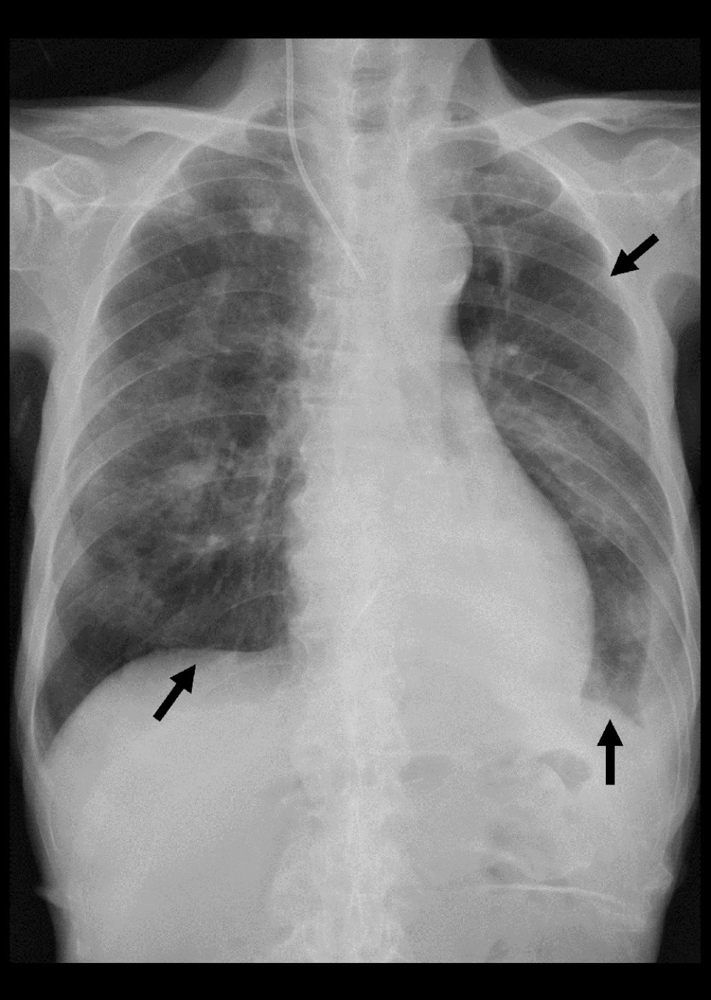 Improved chest X-ray of the patient. Infiltration shadows of the lower lung fields and cavity formation of the upper lung are diminished and have disappeared (arrows).