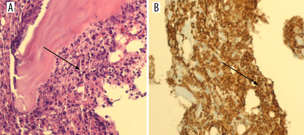 Bone marrow (BM) histology showing large B cell lymphoma cells with diffuse BM involvement >90% BM on hematoxylin/ eosin stain (200×, see image A, black arrow), with positive staining for antibodies to CD20 (200×, see image B, black arrow).