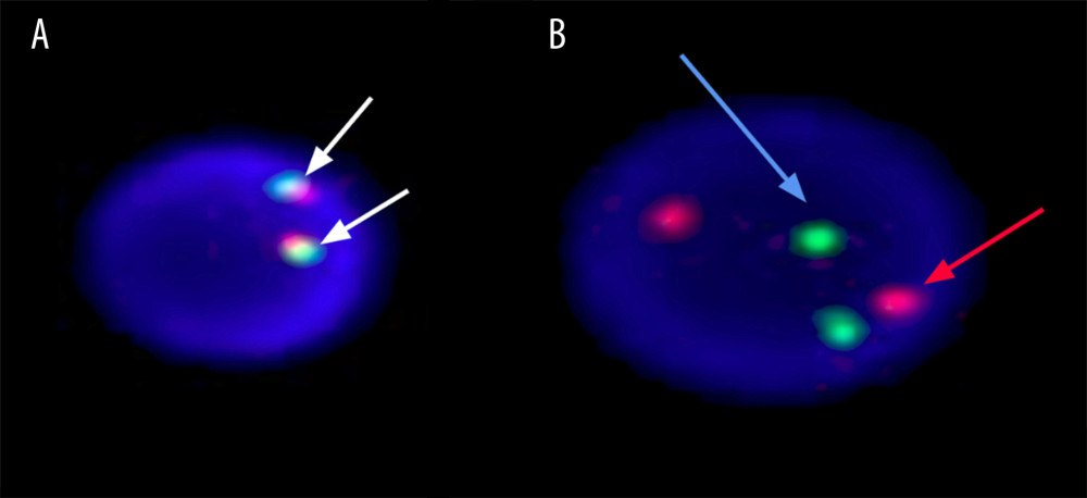 Fluorescence in situ hybridization (FISH) study showing a normal nucleus. Screening for MYC break rearrangement (MYCBA) using the XT MYC BA probe showed two orange/green fusion signals, indicating a negative study (see image A, white arrows). The IGH/BCL2 probe was used to detect t(14;18) translocation. Two green signals (IGH) (see image B, blue arrow) and two orange signals (BCL2) (see image B, red arrow) indicate a negative test result for t(14;18) translocation.