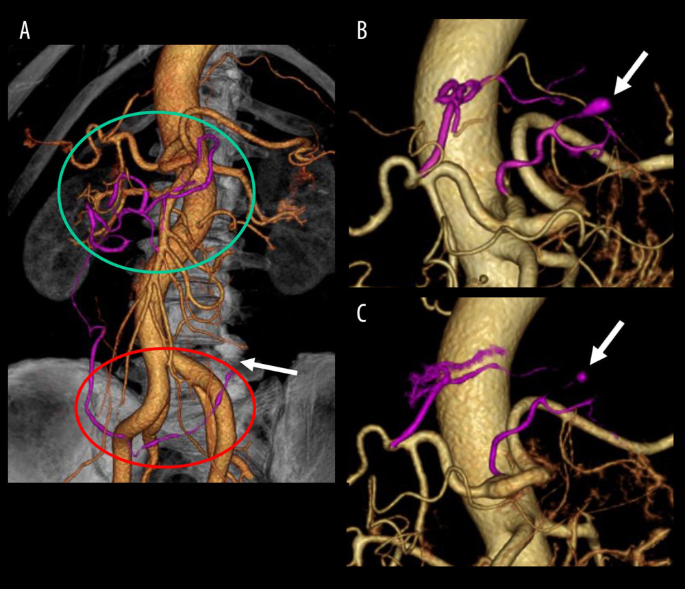 Segmental arterial mediolysis after anti-COVID-19 mRNA vaccination. (A) An abdominal computed tomography shows stenosis and dilatation of multiple visceral arteries, including the middle and right colic arteries (green circle), omental arteries with spindle-shaped dilatation and stenosis (red circle), and left epiploic artery developing occlusion due to arterial dissection (arrow), 58 days after third injection of anti-COVID-19 mRNA vaccination. (B) Fifty-two days after symptom onset, a spindle-shaped aneurysmal structure was observed in the left gastric artery via computed tomography (arrow), while the lesions observed at initial presentation subsided. (C) Seventy-five days after symptom onset, aneurysmal dilatation of the left gastric artery spontaneously resolved (arrow).