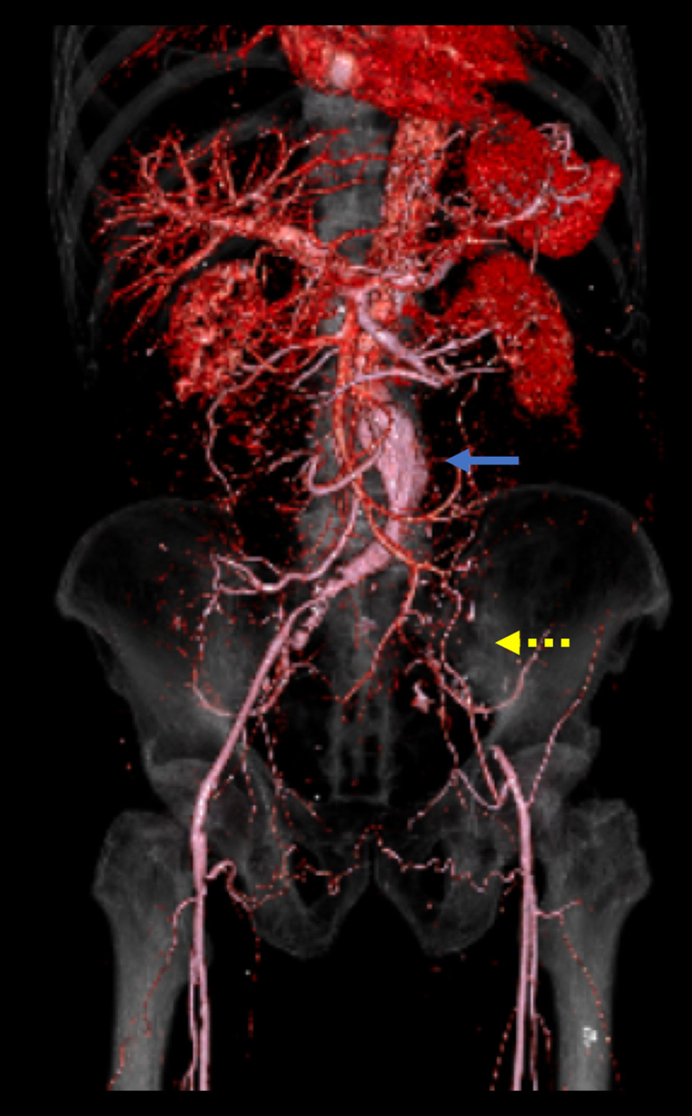 Preoperative computed tomography angiography images. An abdominal aortic aneurysm (solid arrow) and left iliac artery occlusion (dashed arrow) are seen.