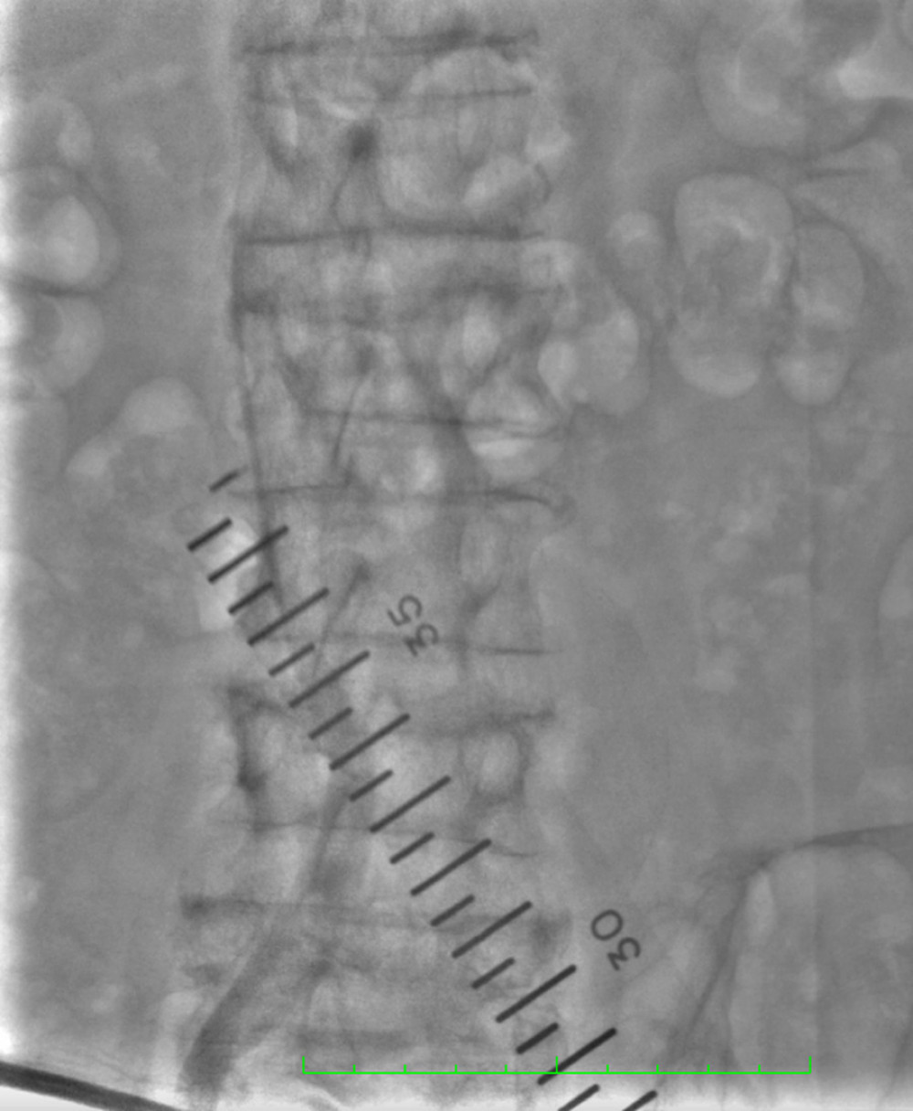 Intraoperative angiography image obtained during iliac artery endovascular recanalization to open the left iliac artery. Angiography performed via the right femoral artery before iliac artery endovascular recanalization.