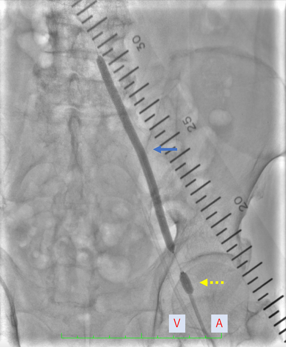 Intraoperative angiography image obtained during iliac artery endovascular recanalization to open the left iliac artery. Ballooning (solid arrow) with a 9-Fr Optimo catheter (dashed arrow; A – artery, V – vein).