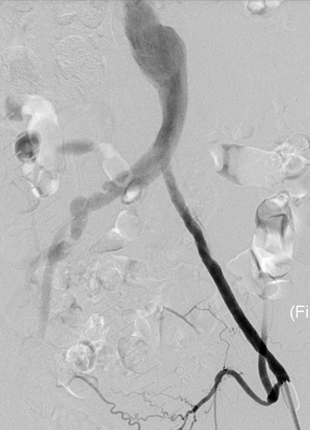 Intraoperative angiography image obtained during iliac artery endovascular recanalization to open the left iliac artery. Angiography performed via the left femoral artery after iliac artery endovascular recanalization.