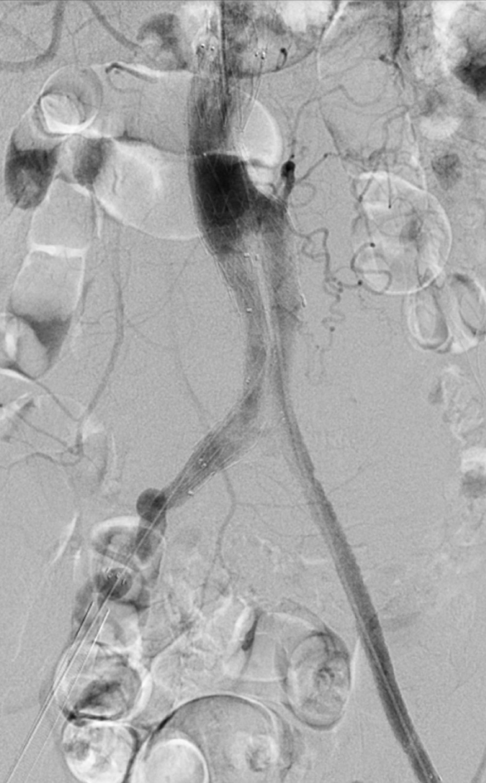 Intraoperative angiography image obtained during endovascular aortic aneurysm repair. Angiography image obtained after endovascular aortic aneurysm repair shows no endoleak.