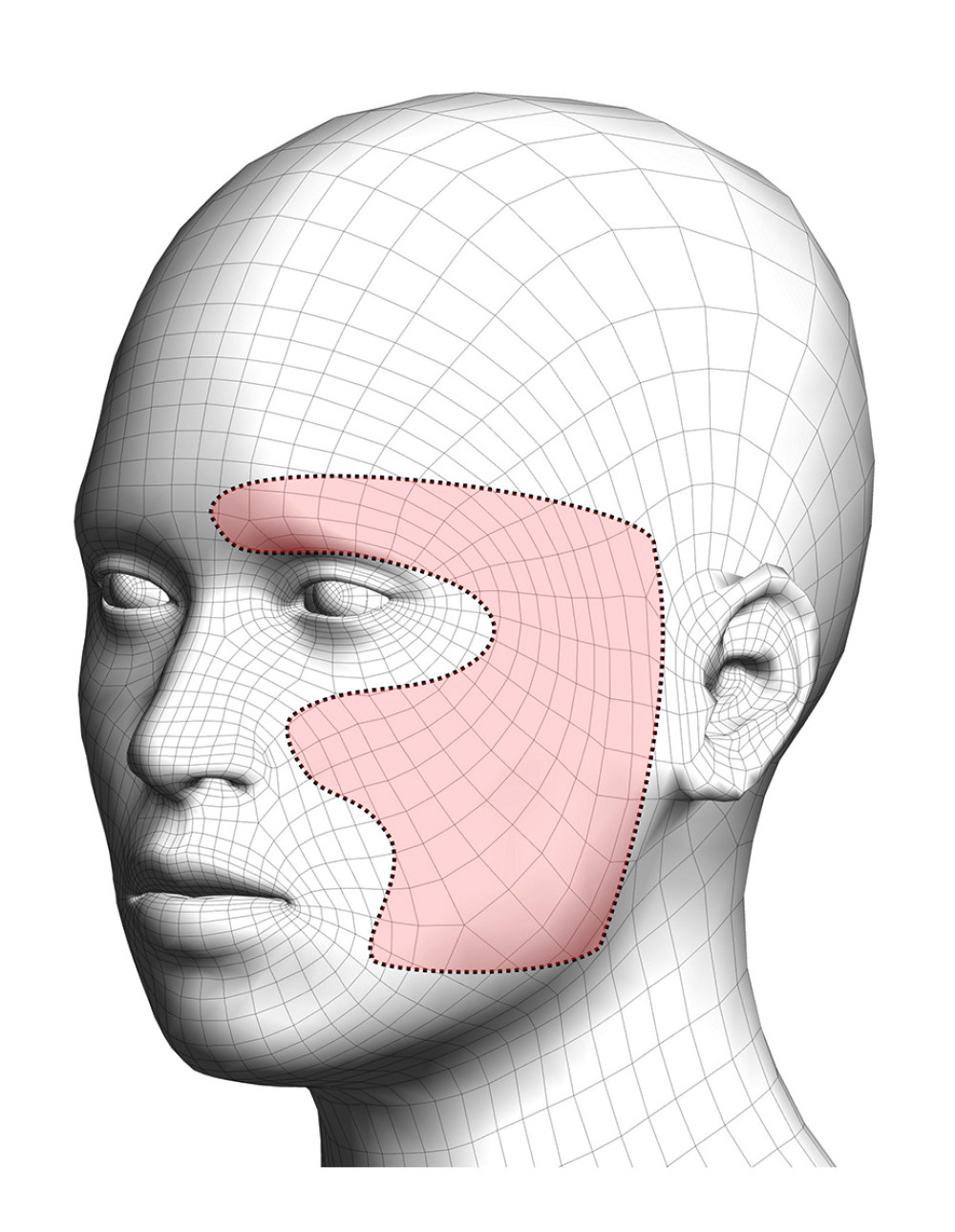 Distribution of the patient’s facial sensory symptoms. The patient noted pain and paresthesia in the highlighted area shown. She also noted a generalized sensation of stiffness and weakness of the facial muscles on the left side of the face. CC0 Public Domain image of face (Piotr Siedlecki; publicdomainpictures. net) modified by RT to illustrate area of symptoms using GIMP GNU Image Manipulation Program version 2.10.30.
