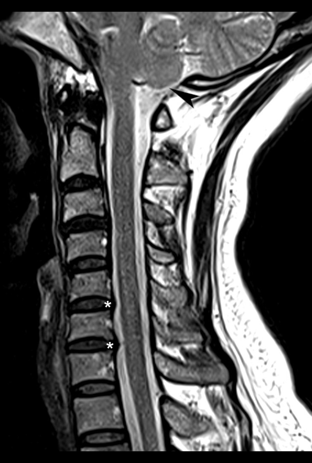 Cervical magnetic resonance imaging, T2-weighted sagittal view. There is evidence of spondylosis, including disc bulges (*), most evident in this view at C5–6 and C6–7. These were small, centrally located, and not contacting the spinal cord. There is no apparent central canal or neuroforaminal stenosis. Low-lying cerebellar tonsils are evident, measuring 0.39 cm inferior to the level of the foramen magnum (arrowhead).