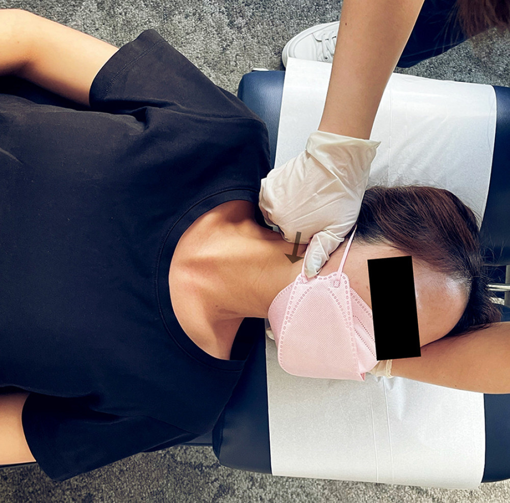 Upper cervical spine manipulation demonstration. As performed in the current case, with the patient supine, the chiropractor places their proximal phalanx on the right articular pillar of the second cervical vertebra, preloads the patient’s neck by placing it in slight ipsilateral lateral flexion and contralateral rotation, and provides a thrust directed lateral to medial and posterior to anterior using the right hand, with the left hand acting to stabilize the head.