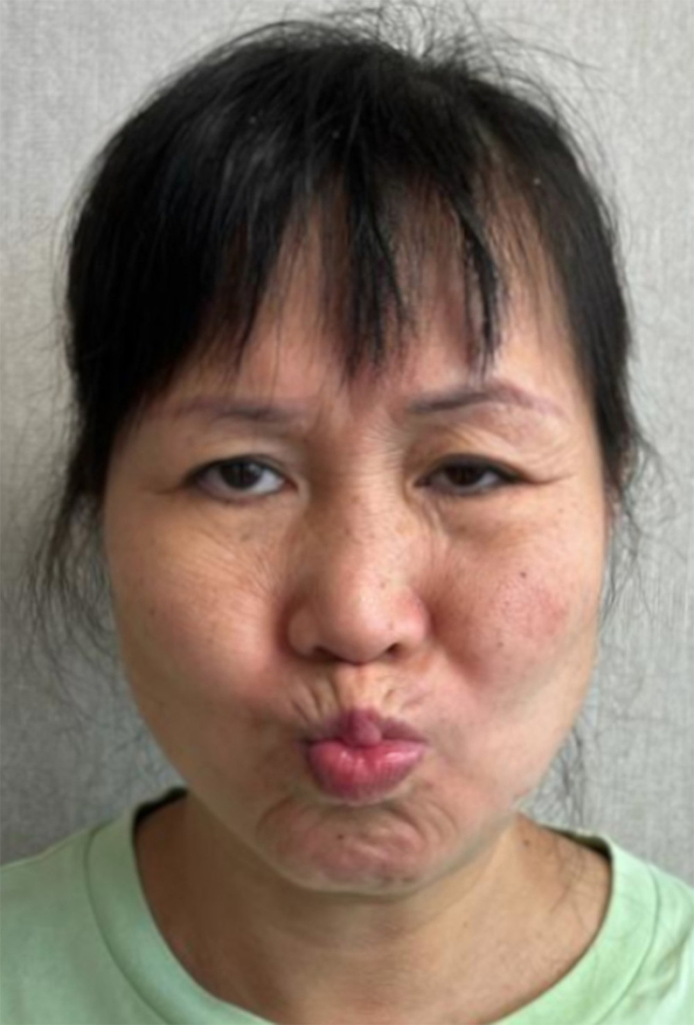 Facial expression at 1-month follow-up. The patient was asked to pucker her lips, which is one of the assessments for facial expressions in patients with Bell’s palsy. While she initially struggled to perform this task, she was now able to do it easily. However, residual synkinesis is evident in the form of a left eyelid droop, which now only occurred when making facial expressions as opposed to also occurring at rest. This image was taken by AC and was used with the patient’s written consent.