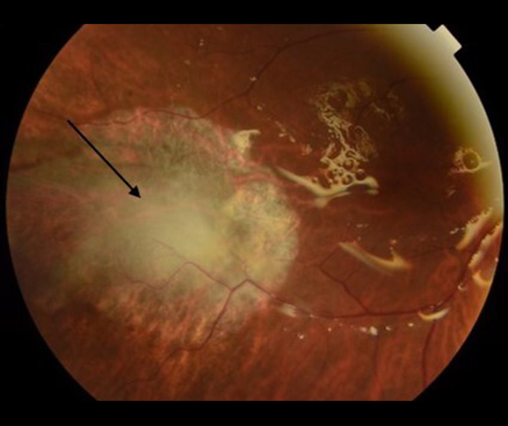 Postoperative right eye showing silicone oil in the vitreous cavity, flat retina, and an extensive necrotic retinal area temporal to the macula (arrow).
