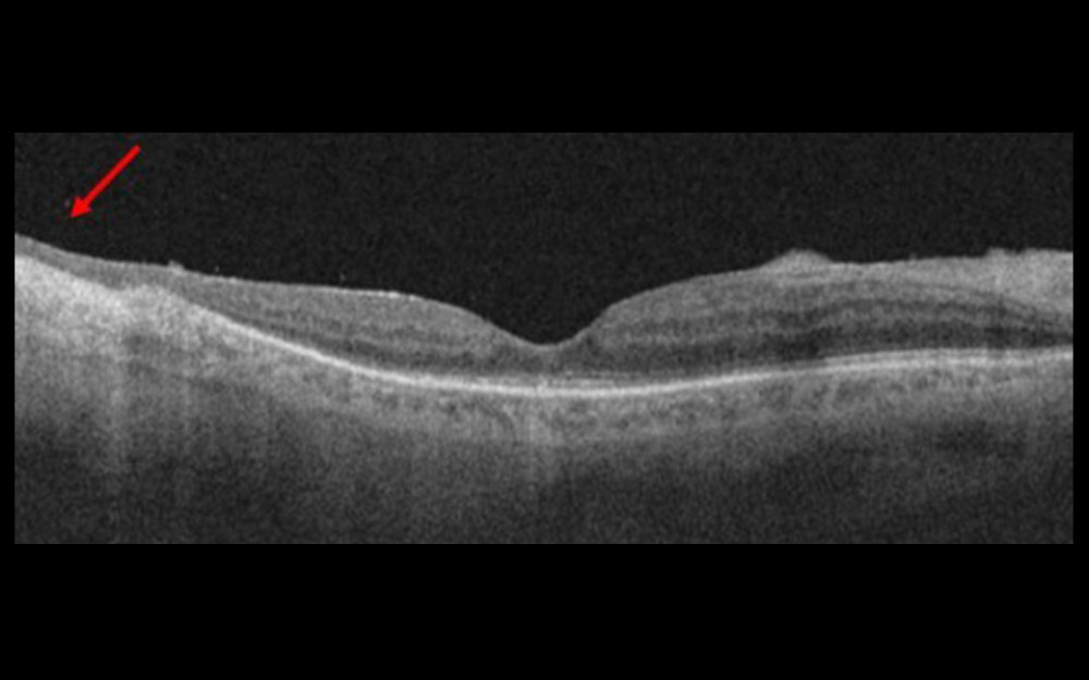 Ten-month postoperative optical coherence tomography scan passing through the fovea showing the atrophic retina (arrow).