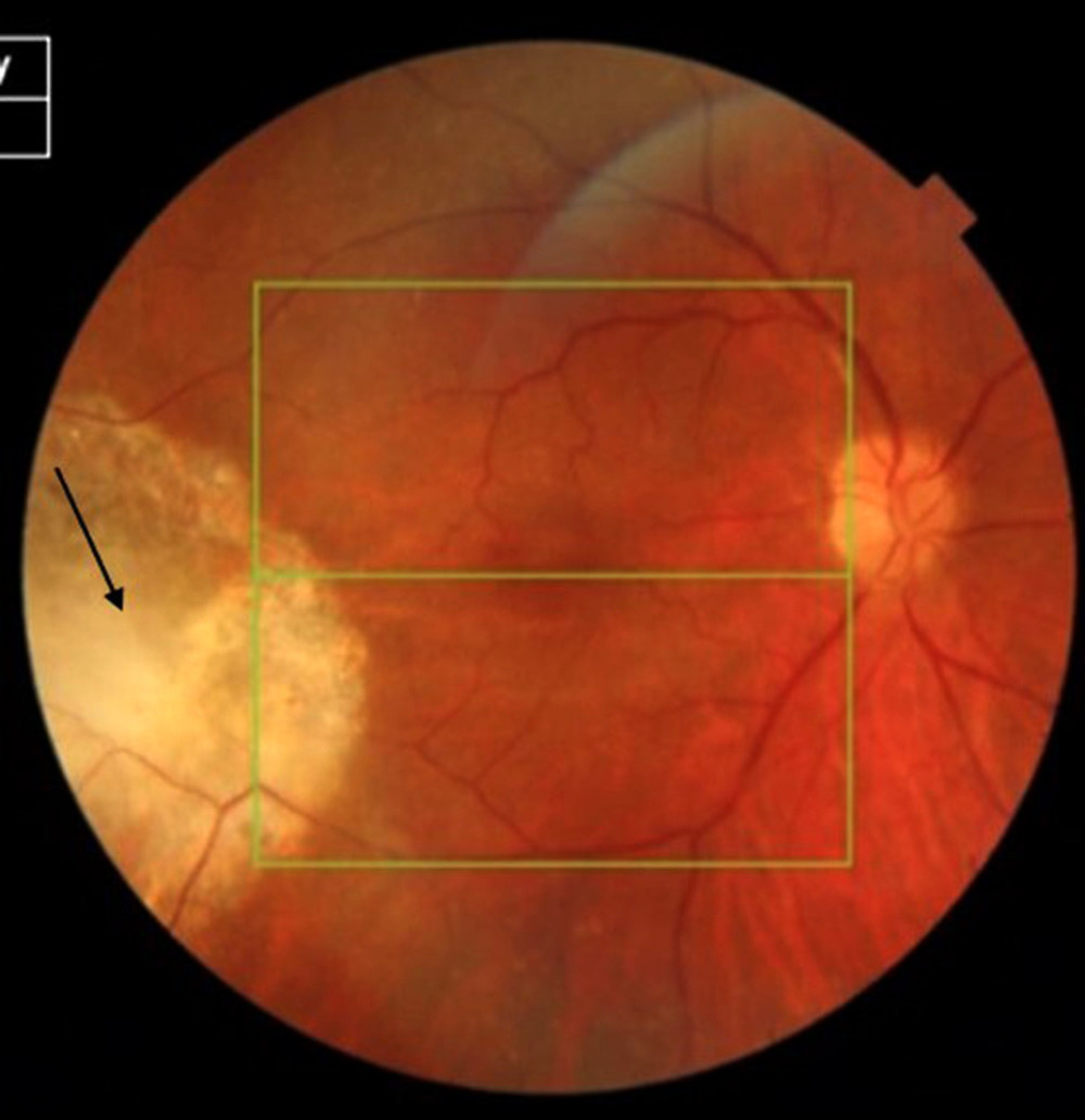 Ten-month postoperative fundus image showing flat retina with an extensive, stable, temporal area of necrotic retina (arrow).