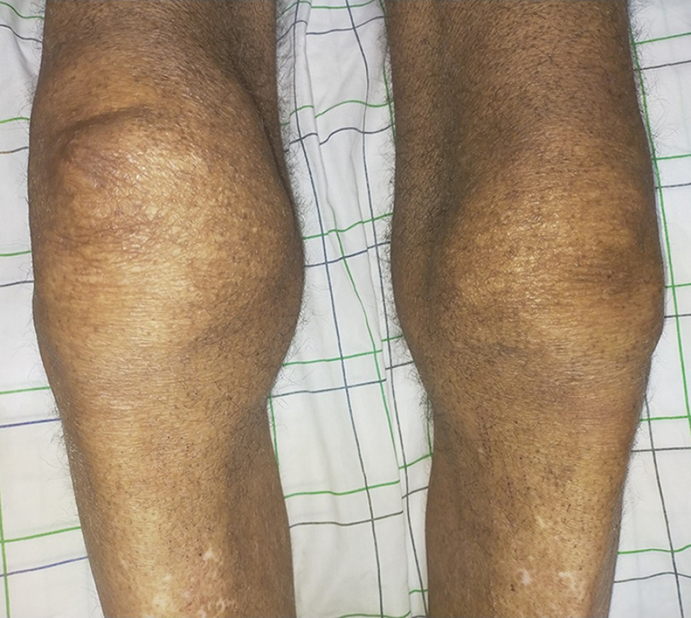 Bilateral knee effusions.