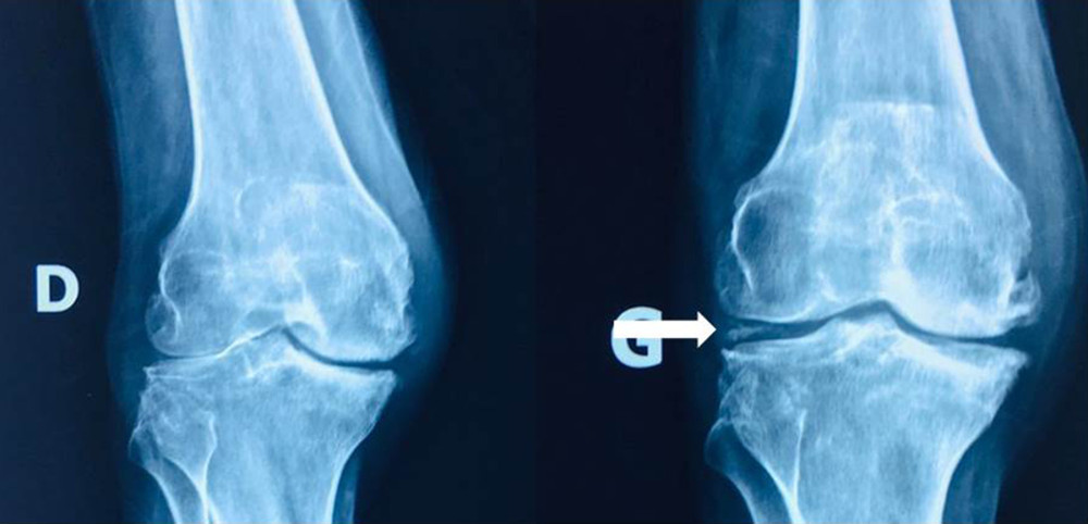 X-rays of both knees showed bilateral osteoarthritis with intra-articular calcification in the left knee (white arrow).