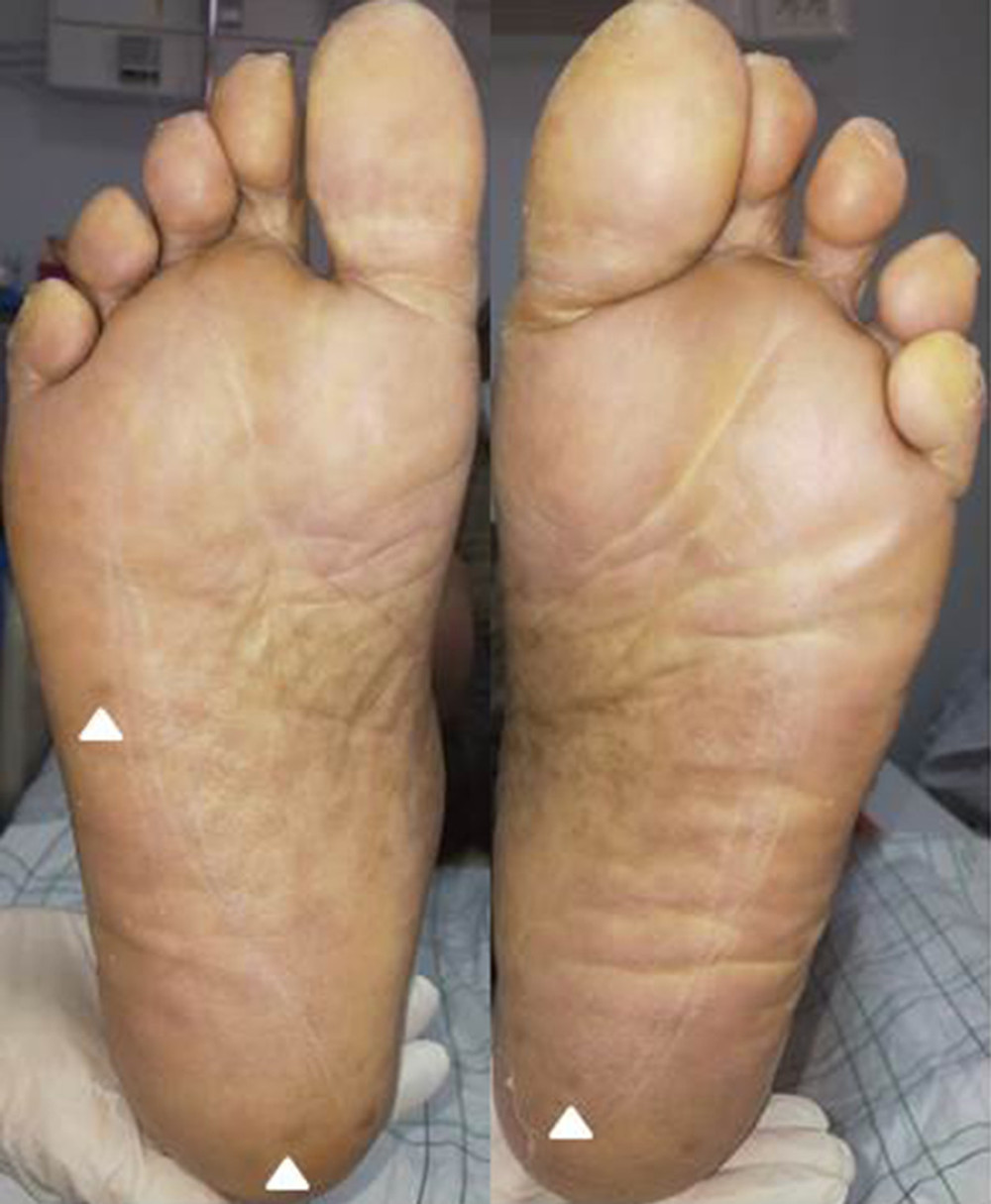 Pigmented papules on the soles (white head arrows).