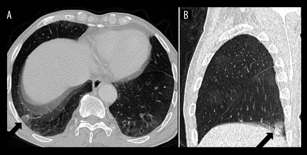 (A) Axial and (B) sagittal plane in chest computed tomography scan with pulmonary window showing focal opacity in the lateral basal segment of the right lung (arrows).