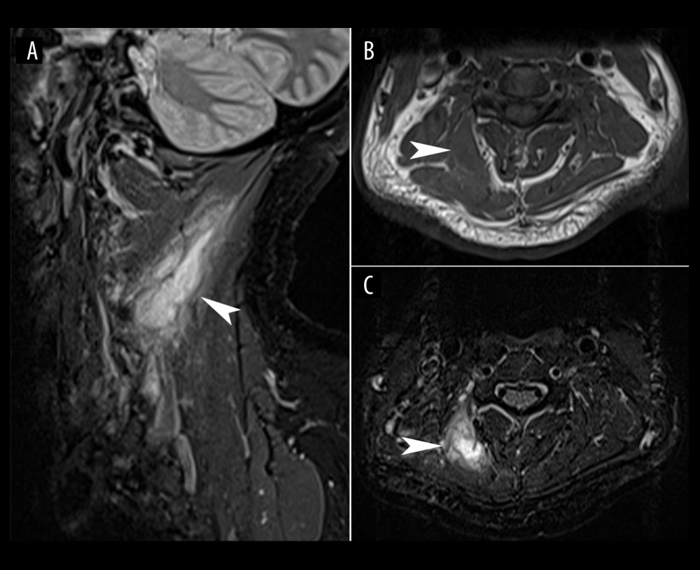 Cervical magnetic resonance imaging suggestive of paraspinal abscess. Short tau inversion recovery (STIR) right parasagittal view (A), and axials at the C4 vertebral segment including a T1-weighted axial (B), and STIR axial (C), showing an intramuscular T1-weighted hypointense, STIR hyperintense lesion at the right posterior paraspinal muscle from C2 to C5 level, measuring 1.97×2.94×4.47 cm (arrowheads).
