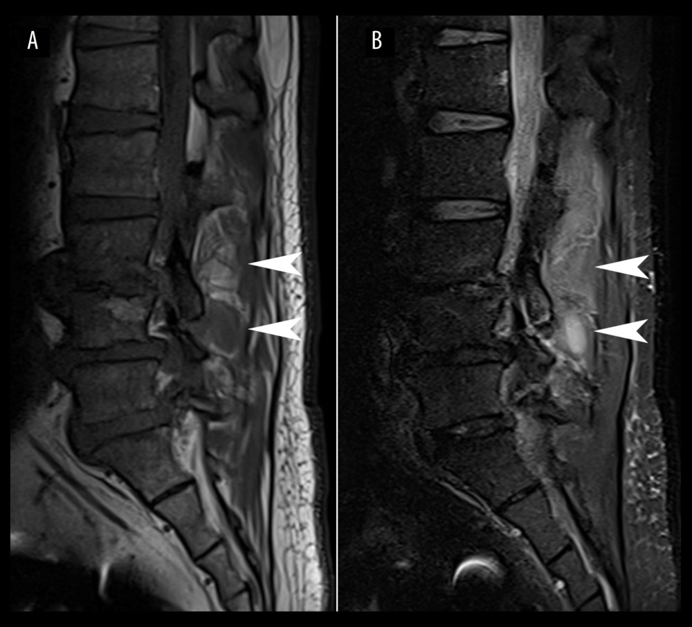 Lumbar right parasagittal magnetic resonance images suggestive of paraspinal abscess. T1-weighted (A) and T2-weighted (B) sections reveal an Ill-defined T1-weighted hypointense, T2-weighted hyperintense lesion at the right posterior paraspinal region from L2/3 to L5 (arrowheads).