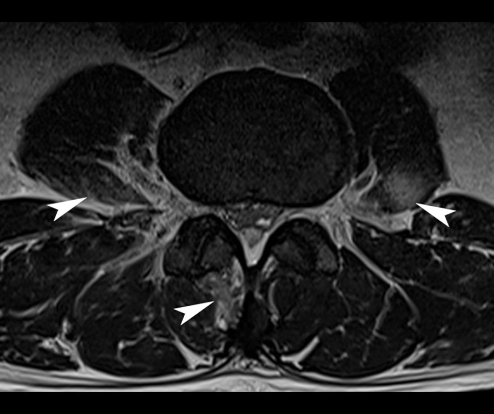 Lumbar spine magnetic resonance image suggestive of psoas and paraspinal abscesses. An axial T2-weighted view at the level of L3 demonstrates T2 hyperintense muscular signal in the psoas muscles bilaterally and right transversospinalis muscles (arrowheads).