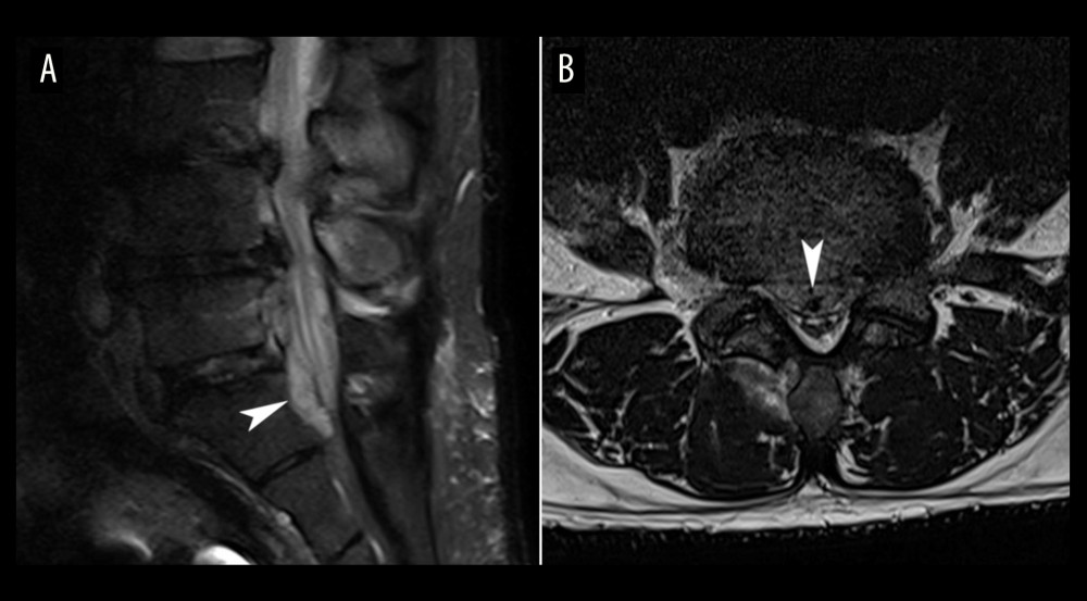 Lumbar magnetic resonance imaging suggestive of epidural abscess. The sagittal short tau inversion recovery (STIR) image (A) and axial T2-weighted image at the level of L5 (B) show an abnormal ventral epidural collection extending from L5 to S1 which is STIR hyperintense and T2 intermediate signal intensity (arrowheads).