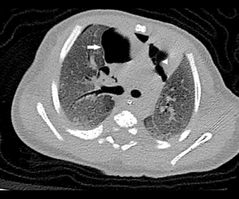 Thoracic CT scan showing small pneumothorax (arrow) with small pneumomediastinum (arrowhead).