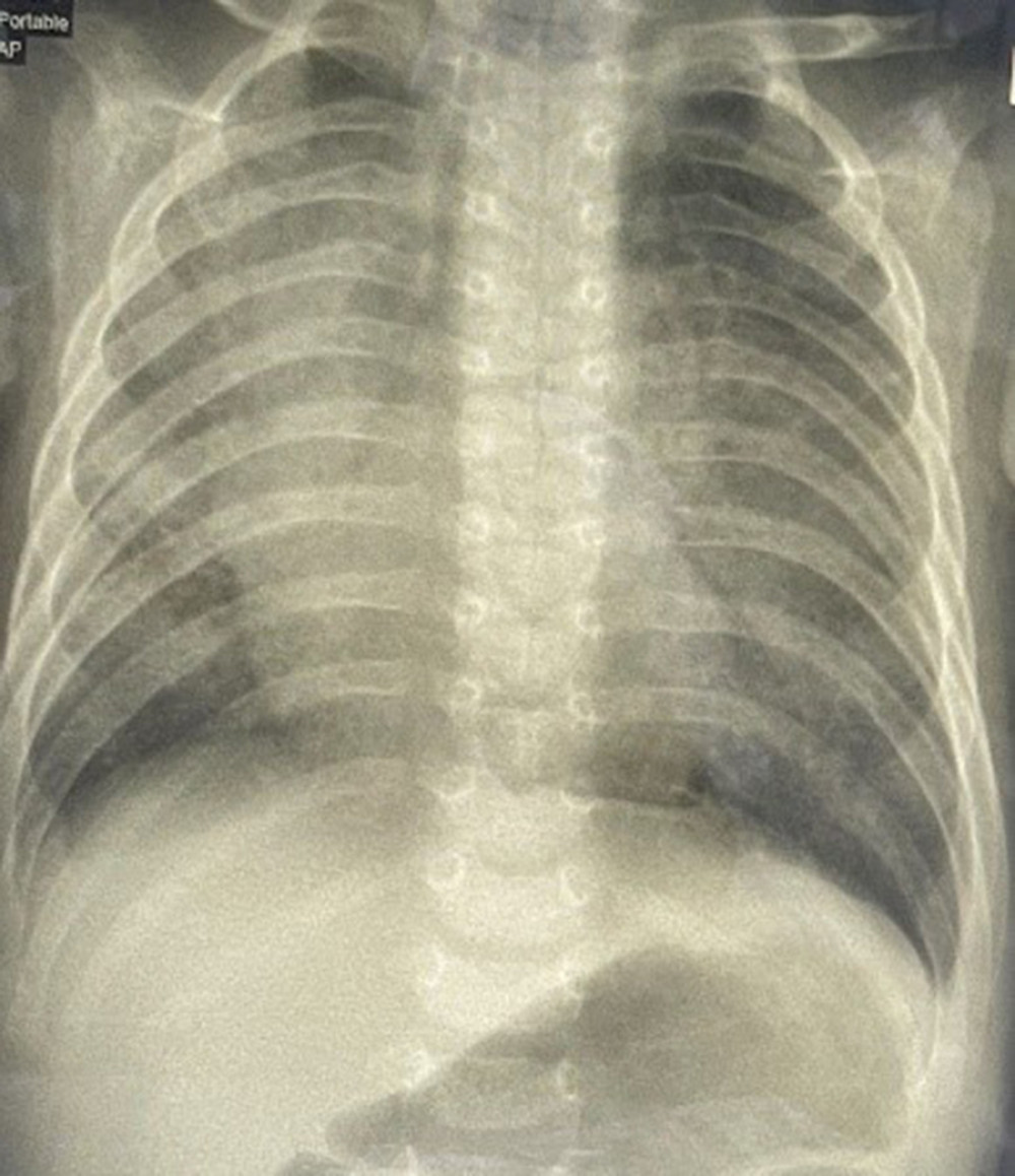 Chest X-ray showing diffuse ground-glass opacity with perihilar bronchial wall thickening.