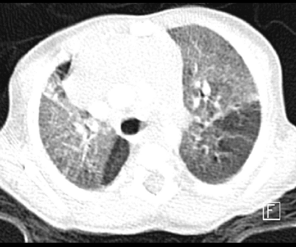 Thoracic CT scan showing interval resolution of right pneumothorax and pneumomediastinum with patchy ground-glass increased density more in upper lobes, right middle lobe, and lingula.