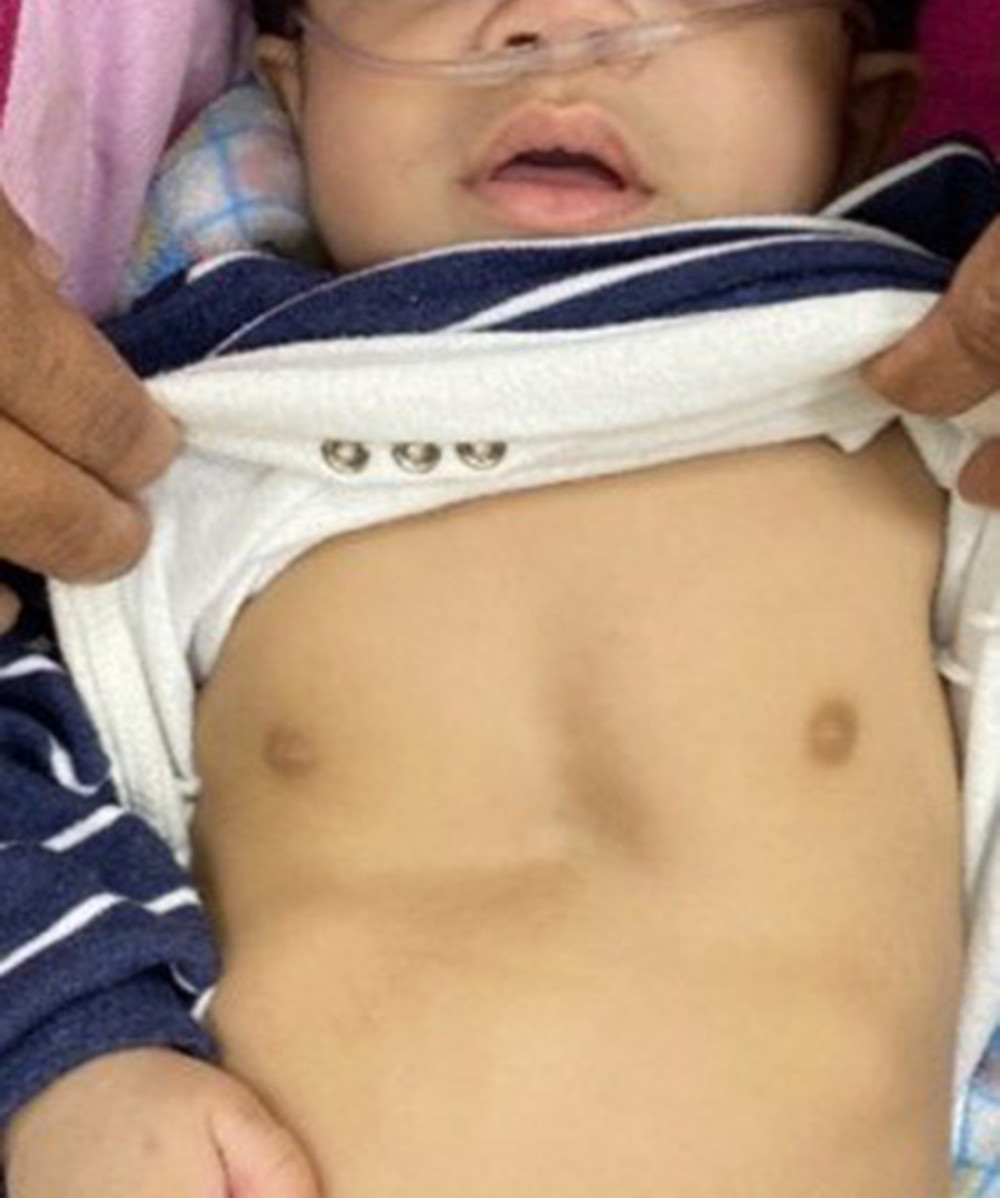 The coarse facial features and pectus excavatum of the patient at age of 10 months. Contractures, joint stiffness, and claw hand are apparent.