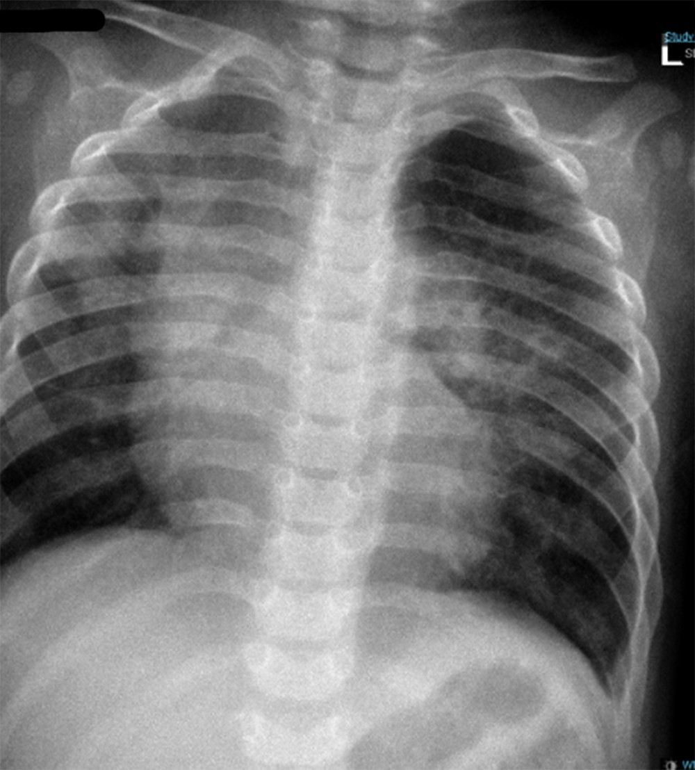 Chest X-ray showing interval improvement regarding to the ground-glass appearance of both lung fields after starting idursulfase therapy.